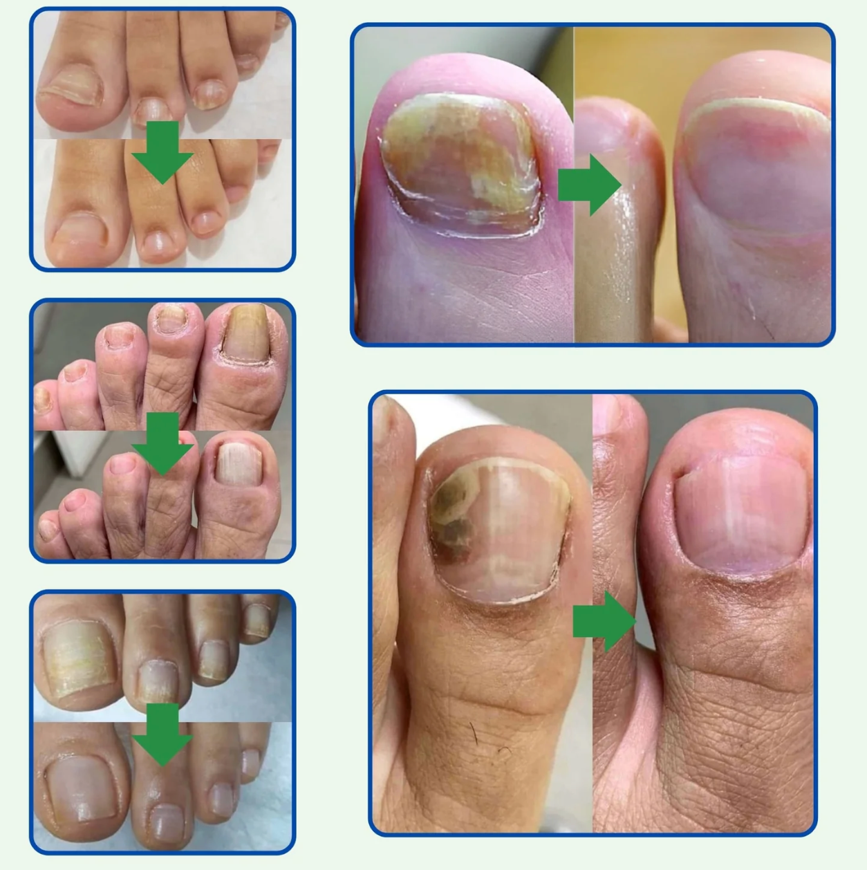 ¡Di adiós a los hongos en las uñas en solo 7 días con 100% ingredientes naturales!"