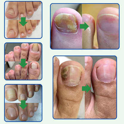 ¡Di adiós a los hongos en las uñas en solo 7 días con 100% ingredientes naturales!"