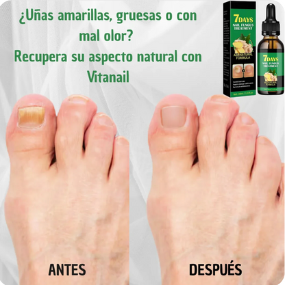 ¡Di adiós a los hongos en las uñas en solo 7 días con 100% ingredientes naturales!"