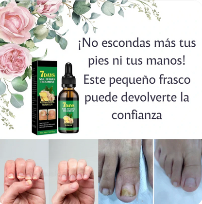 ¡Di adiós a los hongos en las uñas en solo 7 días con 100% ingredientes naturales!"