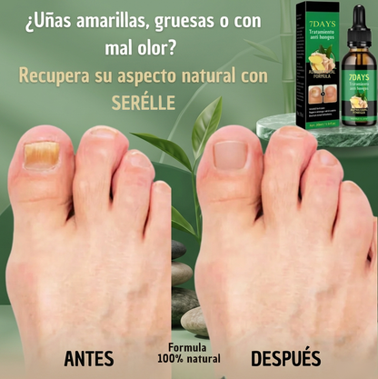 ¡Despidete de los hongos en las uñas en solo 7 días con 100% ingredientes naturales!